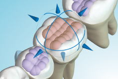 023 Posterior bite turbos